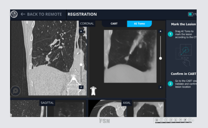 Lung Cancer Platform Now Available, DetectedX