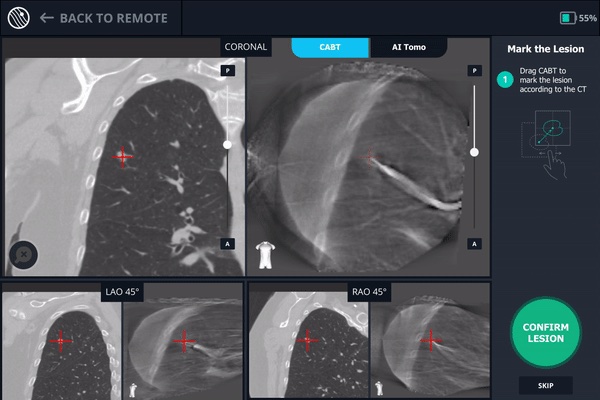 Overcoming CT-to-Body Divergence to Biopsy, Definitively Diagnose and Mark  a Subcentimeter Lesion